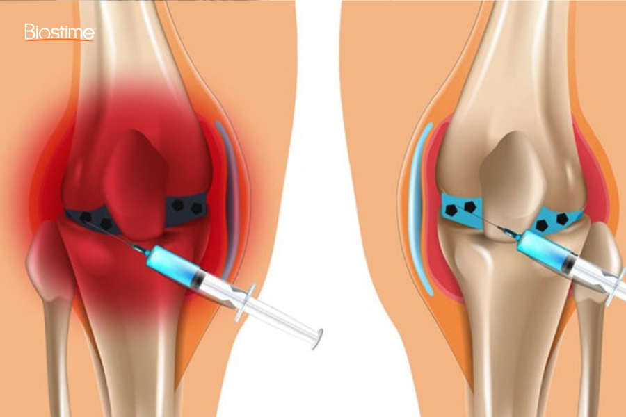 Bác sĩ sẽ dùng kim vô trùng chọc hút dịch từ khớp để phân tích dưới kính hiển vi