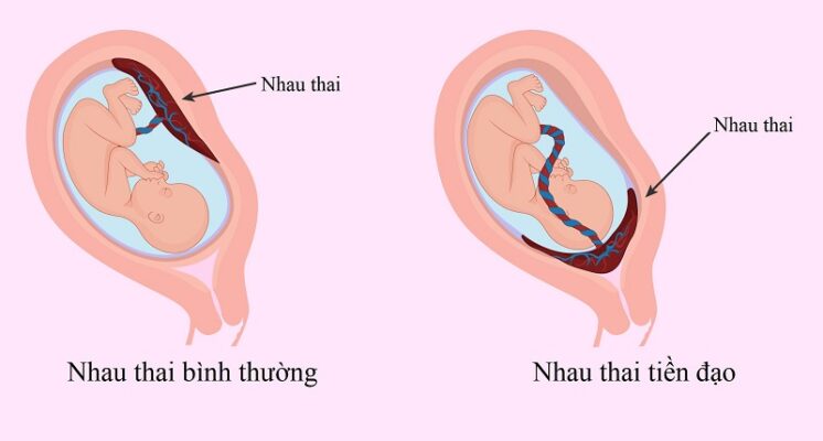Nhau tiền đạo là biến chứng sản khoa nguy hiểm 